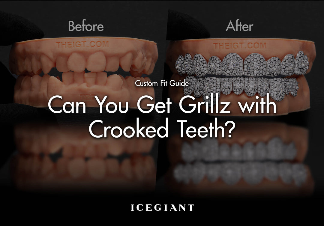 Custom Fit Guide: Can You Get Grillz with Crooked Teeth? 
