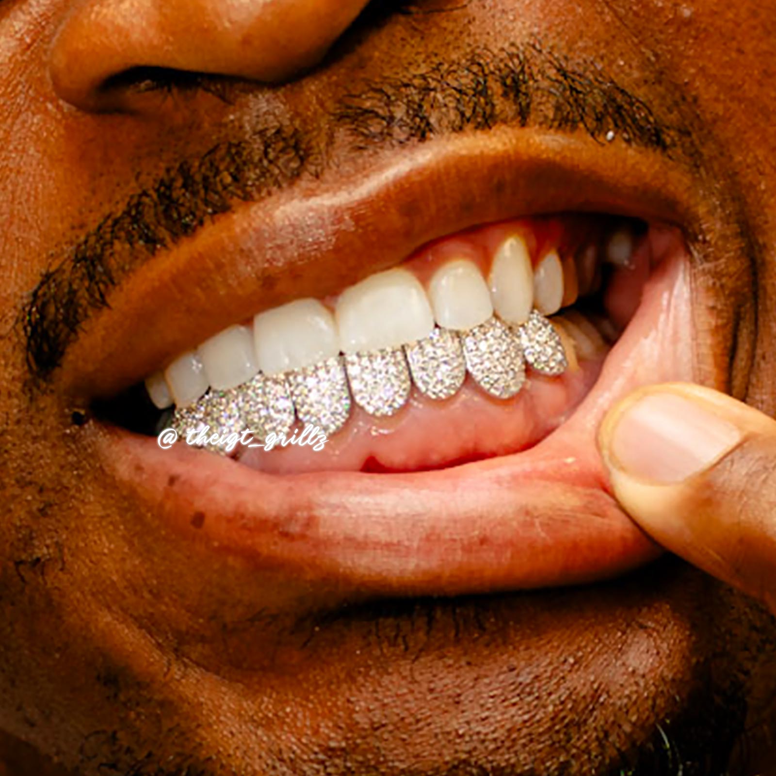 Custom Fully Iced Honeycomb Rimless Setting Grillz